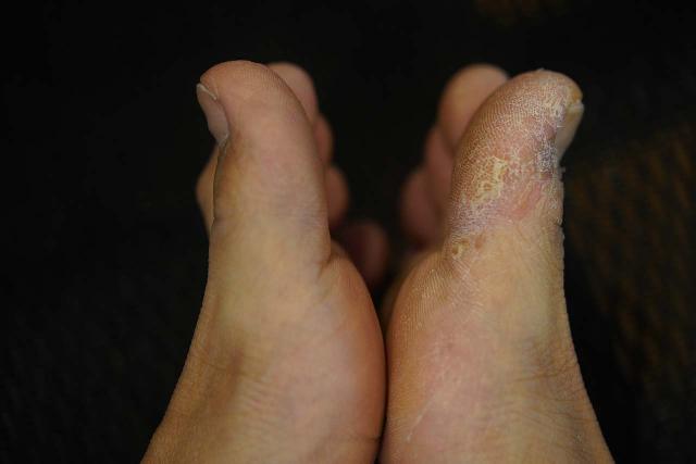 Picture of my feet where the left foot was free of athletes foot, but the right foot suffered from it. I blamed this fungal growth affliction on my hiking boot getting inundated with water on a hike that happened years ago yet the hardy fungus continues to live in that boot