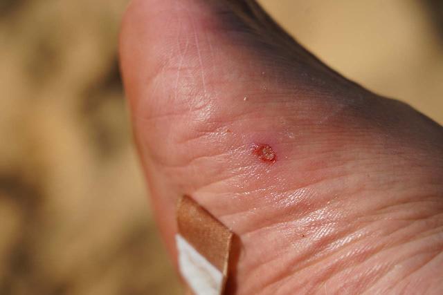 In the aftermath of the Hakanapi'ai Falls hike where I wore Keens for the whole hike, it caused this bursted blister, which made it prone to leptospirosis infection